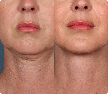 Qooes 4D Hyaluronic Deep Hydration & Age-Defying Serum