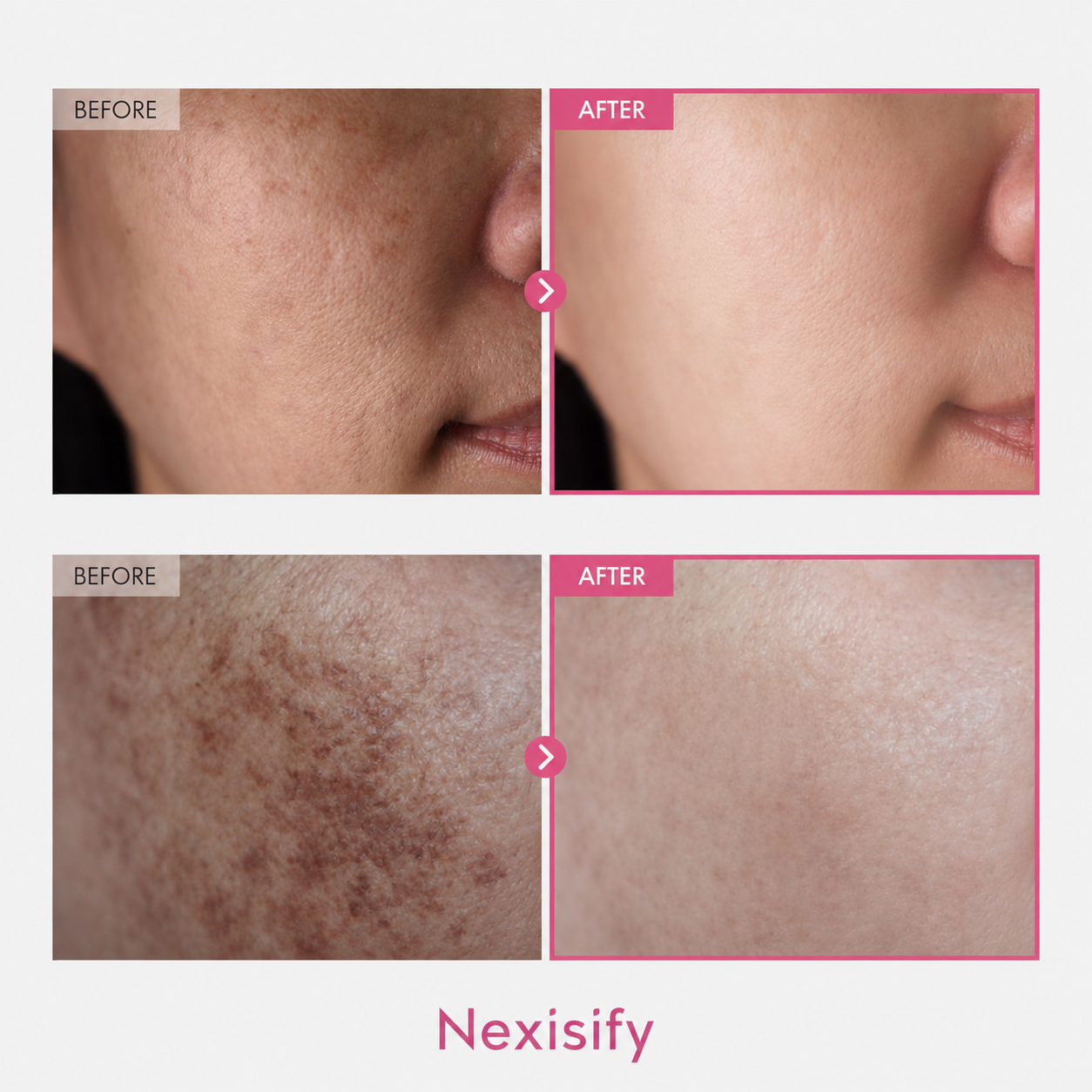 ✨ Nexisify 7% Arbutin + 4% Tranexamic Acid Dark Spot Cream