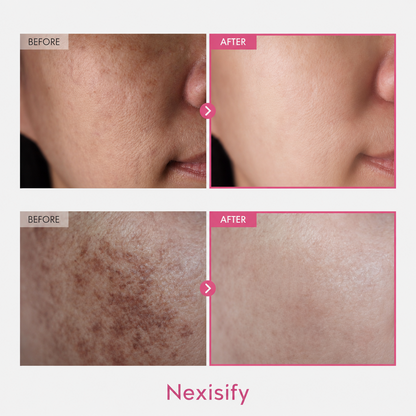 ✨ Nexisify 7% Arbutin + 4% Tranexamic Acid Dark Spot Cream