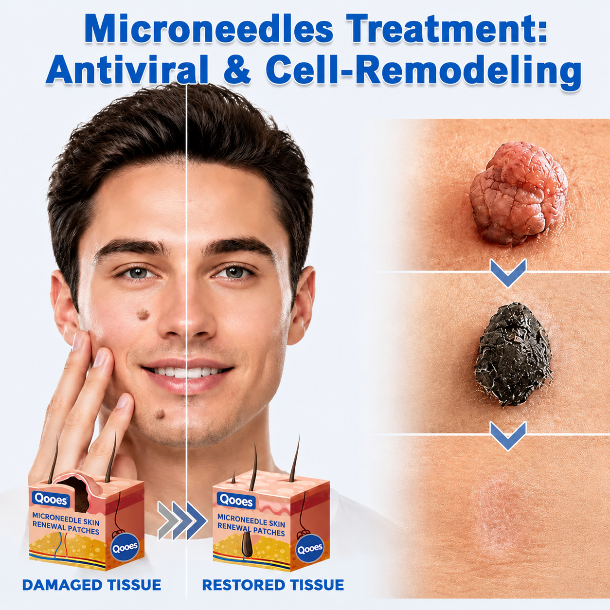Qooes®2-in-1 Microneedle & Hydrocolloid Patch👨‍⚕️ | Removes raised moles, acne, flat warts, and skin tags | Helps improve wrinkles, scars, and blemishes | Invisible patches for face and body💖