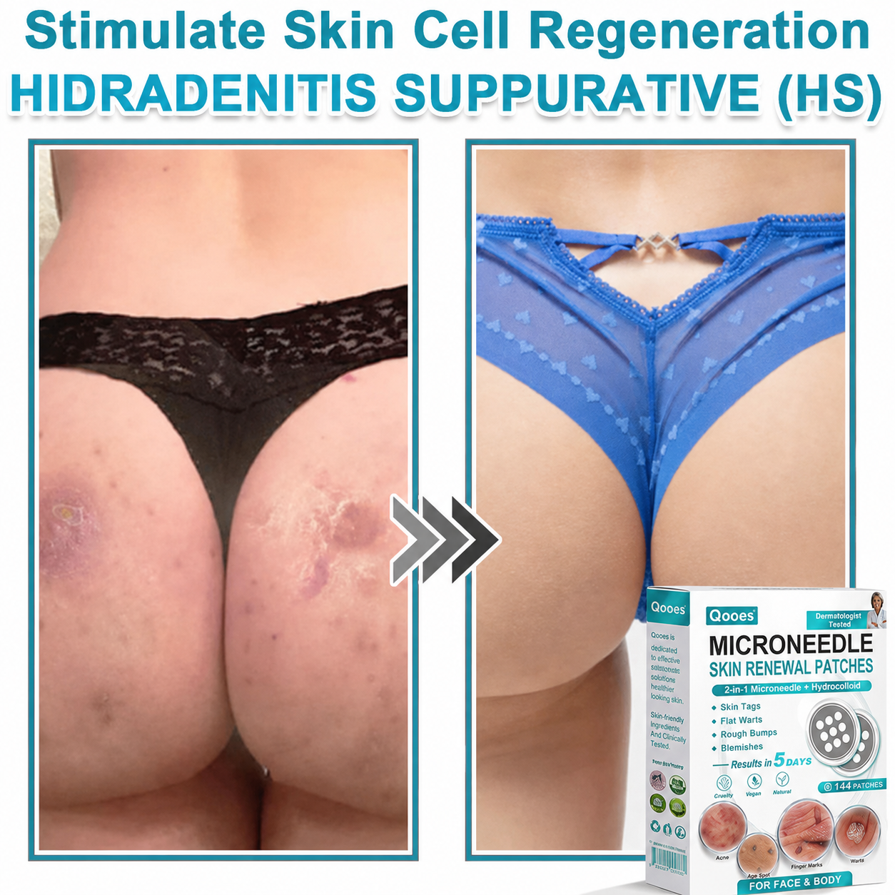 Qooes®2-in-1 Microneedle & Hydrocolloid Patch👨‍⚕️ | Removes raised moles, acne, flat warts, and skin tags | Helps improve wrinkles, scars, and blemishes | Invisible patches for face and body💖