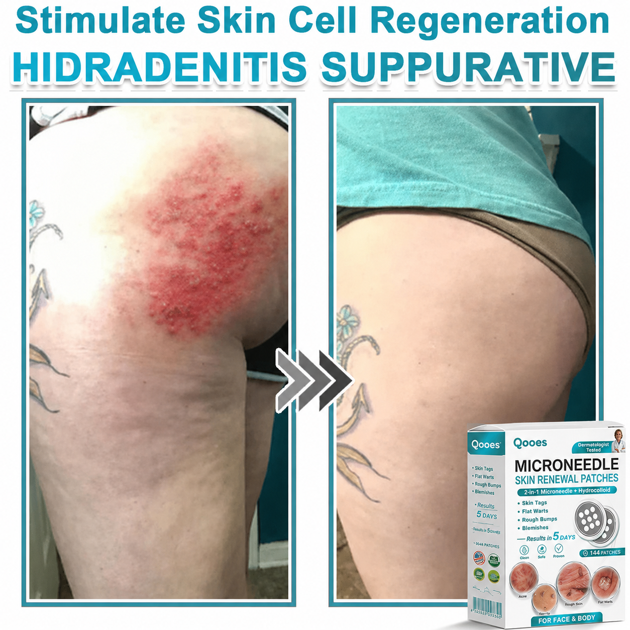 Qooes®2-in-1 Microneedle & Hydrocolloid Patch👨‍⚕️ | Removes raised moles, acne, flat warts, and skin tags | Helps improve wrinkles, scars, and blemishes | Invisible patches for face and body💖